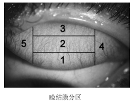 軟性接觸鏡臨床評(píng)價(jià)注冊(cè)審查指導(dǎo)原則(2023年第33號(hào))(圖1) 軟性接觸鏡臨床評(píng)價(jià)注冊(cè)審查指導(dǎo)原則(2023年第33號(hào))(圖1)