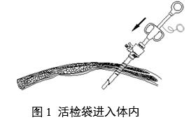 一次性使用內(nèi)窺鏡用活檢袋注冊審查指導(dǎo)原則(2025年第20號(hào))(圖1) 一次性使用內(nèi)窺鏡用活檢袋注冊審查指導(dǎo)原則(2025年第20號(hào))(圖1)